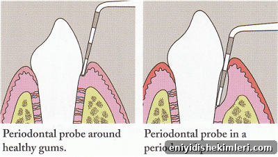Does a Dental Cleaning Hurt? What to Expect at Your Visit 3 periodontal probe
