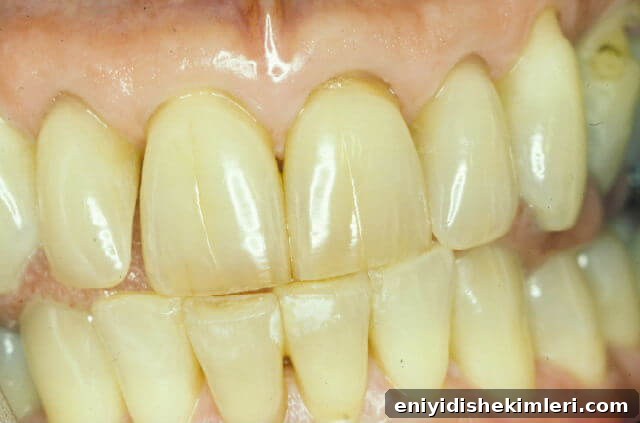 Prevent Teeth Yellowing: Top Tips to Maintain a Bright Smile 2 yellow dentin from grinding