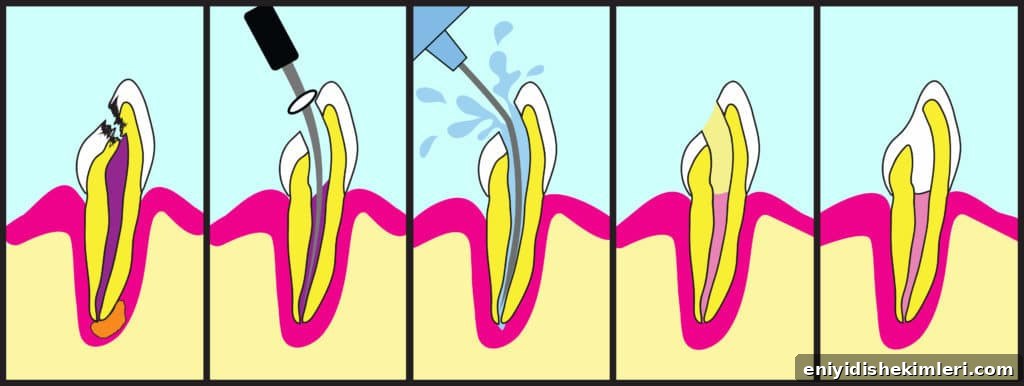 Root Canal Treatment Guide: What to Expect and Alternatives 2 root canal procedure, root canal illustration, what to expect during a root canal