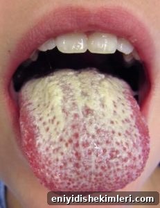 candida in the mouth